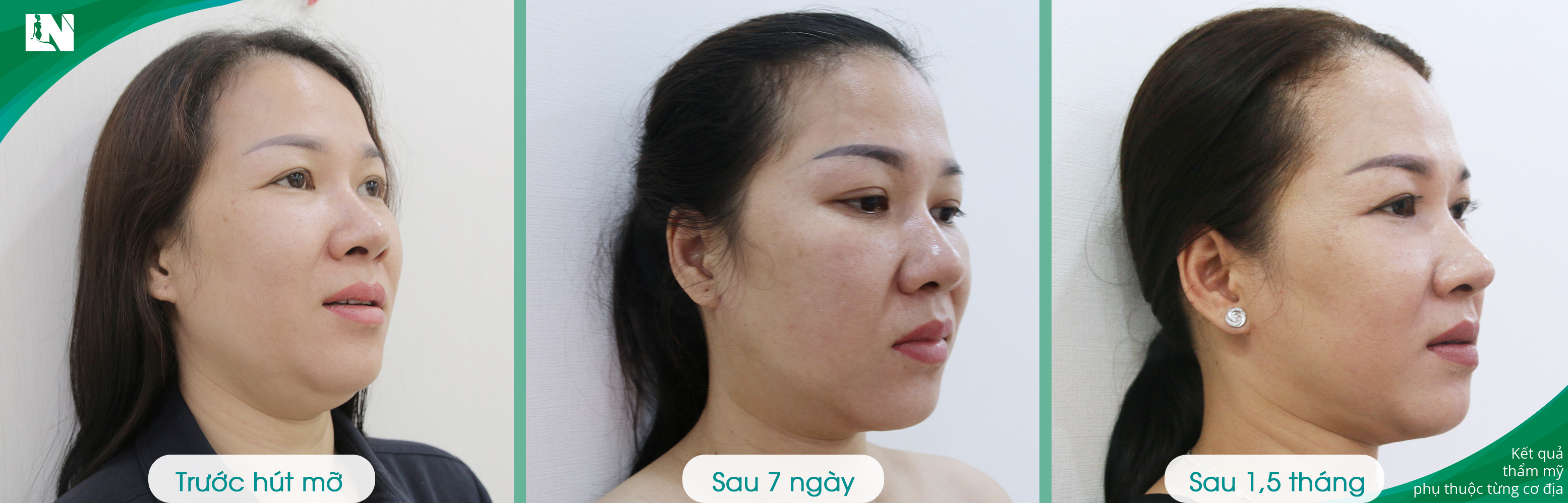 Hình ảnh Khách hàng trước - sau 1,5 tháng hút mỡ nọng cằm bởi Bác sĩ Lương Ngọc