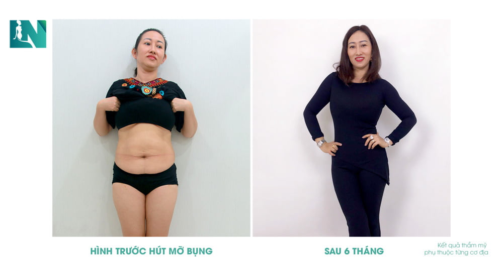 Hút mỡ bụng ở Đồng Nai