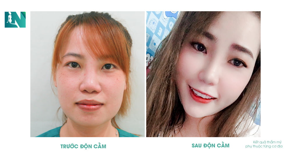 Hình ảnh trước và sau khi thẩm mỹ khác – Bs.Lương Ngọc