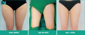 Hút mỡ đùi bao lâu bình thường