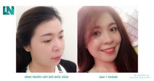Có nên hút mỡ mặt hay không
