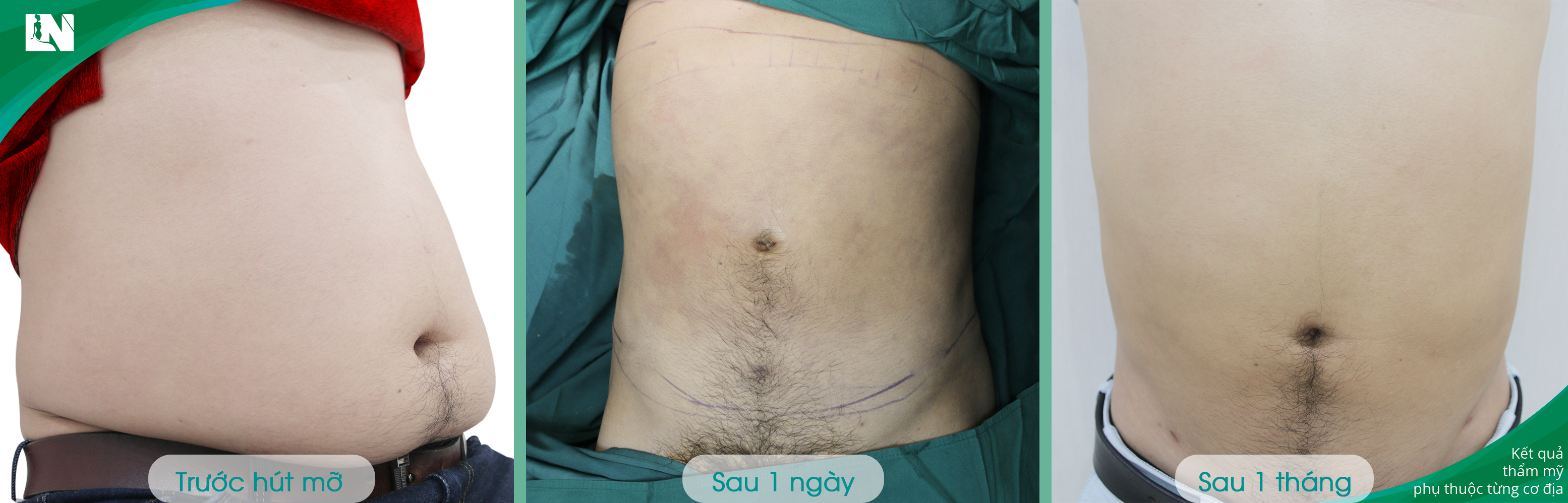 Hình ảnh Khách hàng trước - sau 1 tháng hút mỡ bụng không phẫu thuật