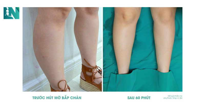 Làm sao để giảm mỡ bắp chân