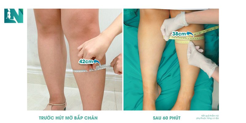 hút mỡ bắp chân bao nhiêu tiền