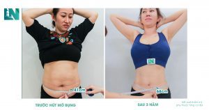 Hút mỡ bụng có tốt không