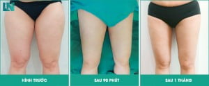 hút mỡ đùi bao nhiêu tiền