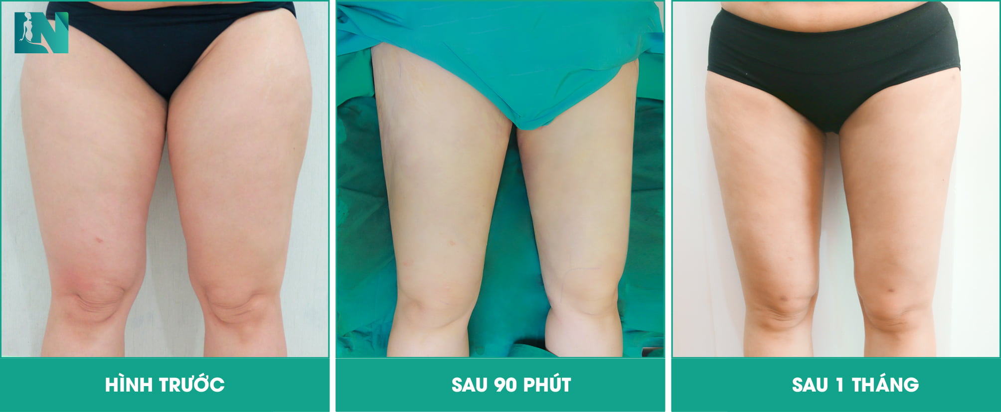 hút mỡ đùi có đau không