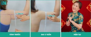 review hút mỡ bắp tay