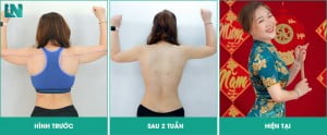 Chăm sóc sau khi hút mỡ bắp tay