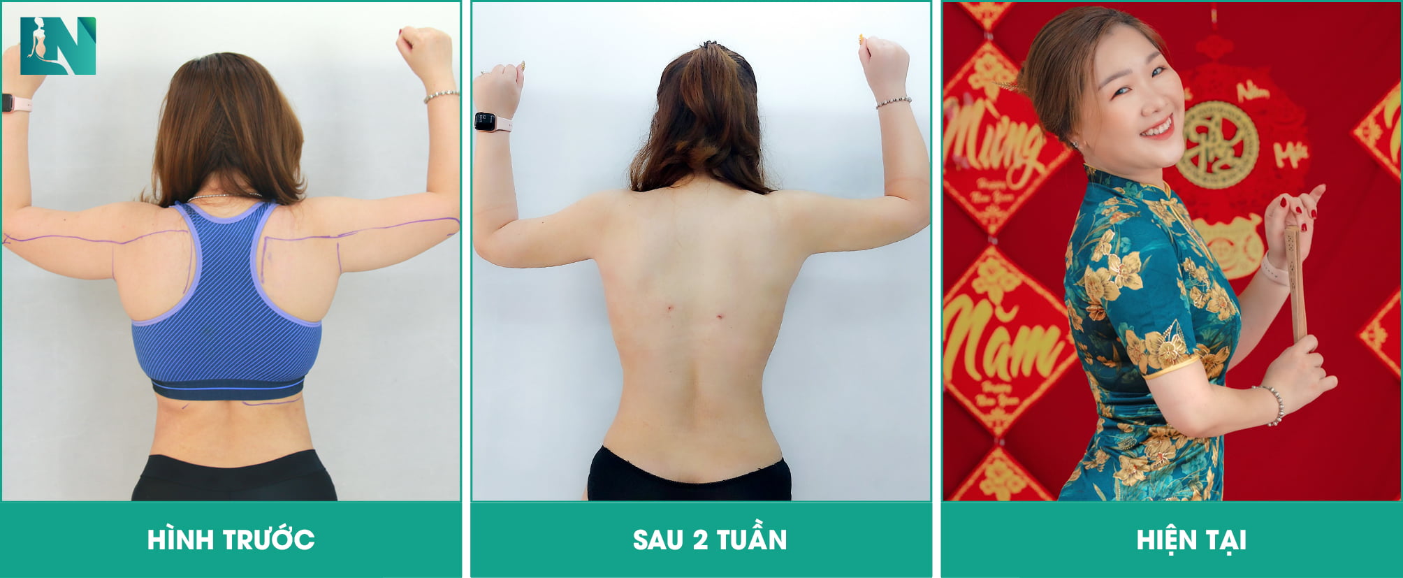 Hút mỡ bắp tay có to lại không