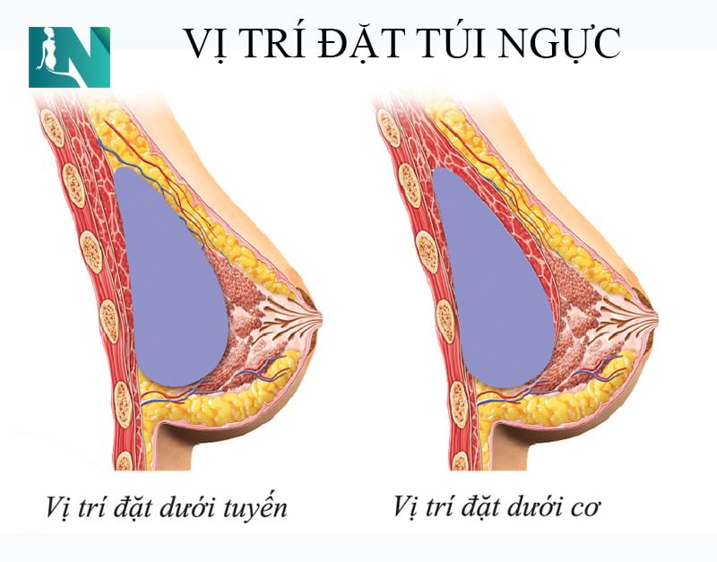 nên đặt túi ngực trên cơ hay dưới cơ