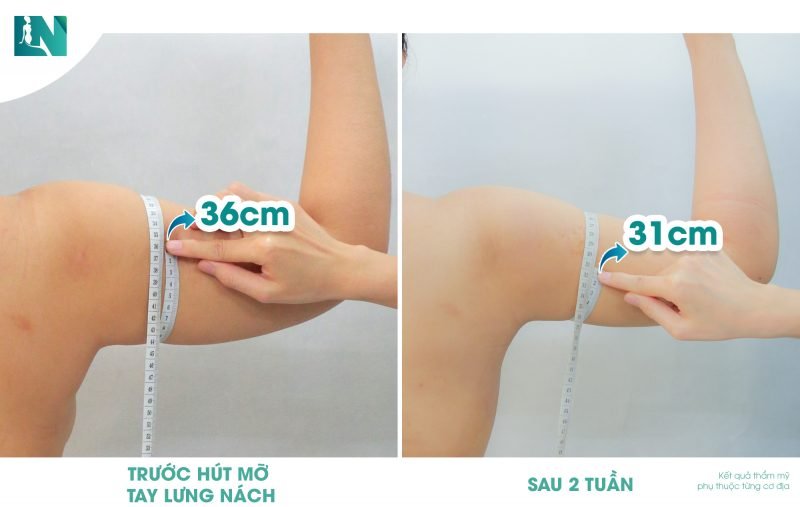 hút mỡ cánh tay có đau không