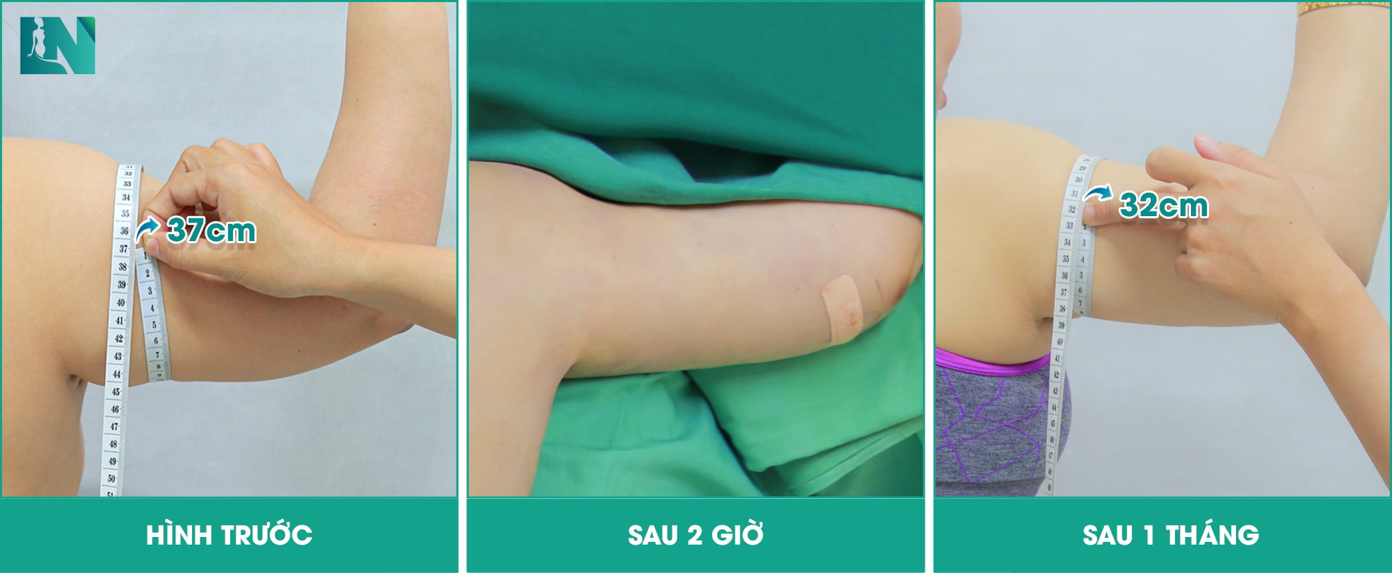 Hút mỡ bắp tay cần đeo gen bao lâu