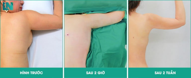Hút mỡ bắp tay chị bích ngọc