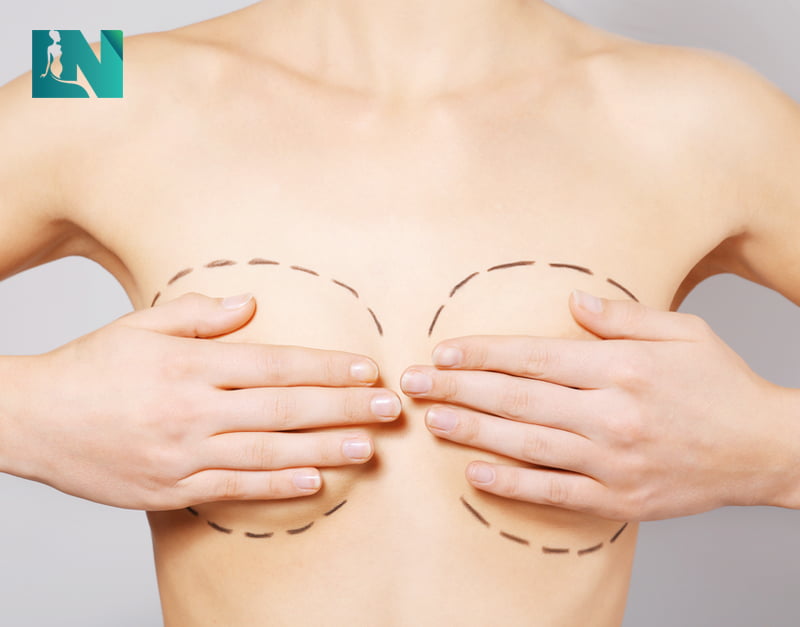 đặt túi ngực hình giọt nước