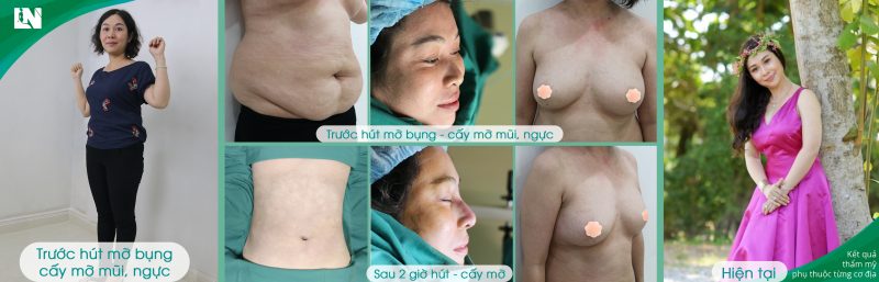 Hình ảnh Khách hàng trước - sau cấy mỡ mũi, ngực thực hiện bởi Bác sĩ Lương Ngọc