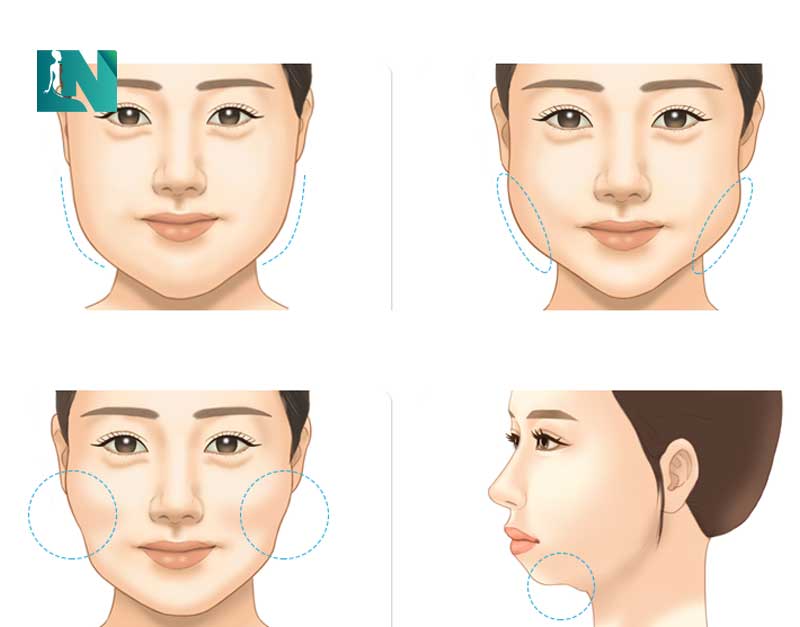 có nên hút mỡ má không