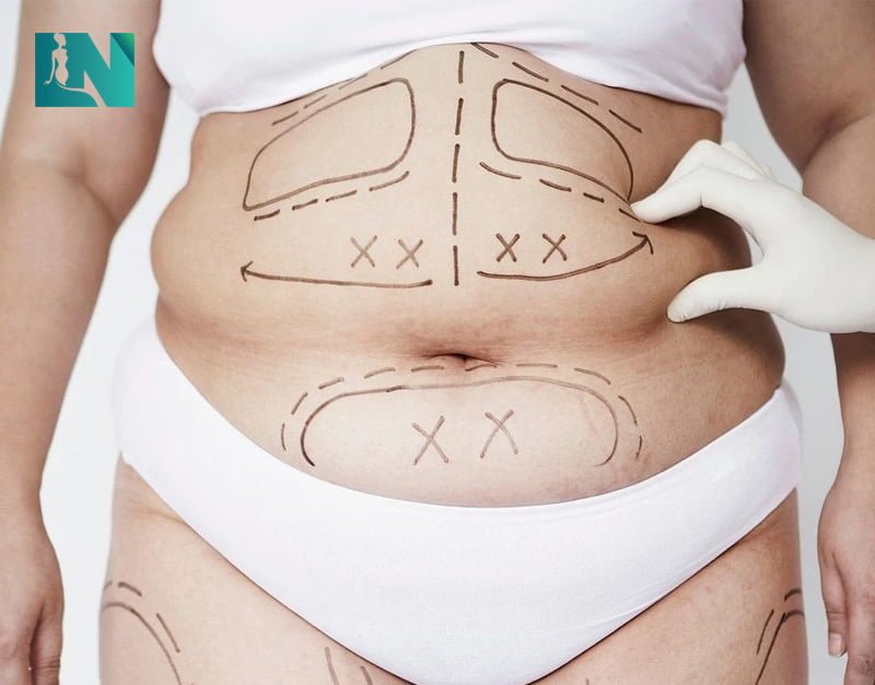 Hút mỡ bụng bằng sóng siêu âm có ảnh hưởng gì không