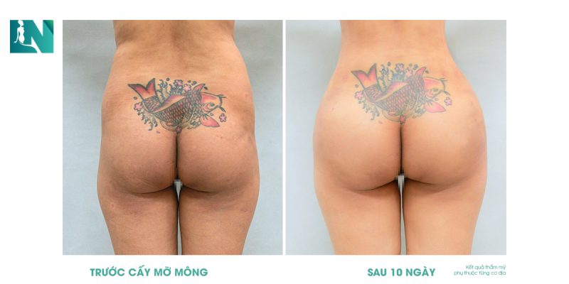 Nâng mông bằng mỡ tự thân