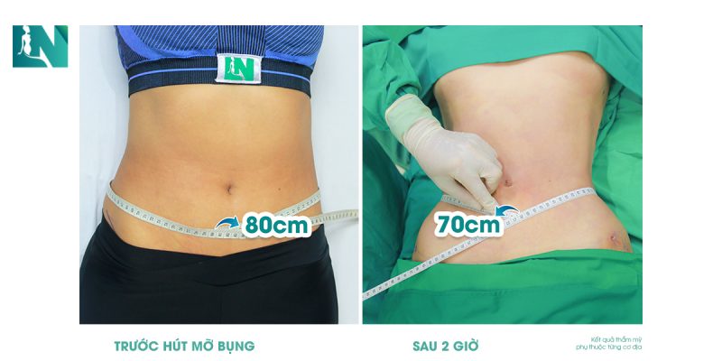 hút mỡ bụng có để lại sẹo không