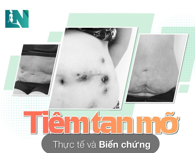 Cách giảm mỡ toàn thân hiệu quả