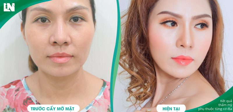 Chi phí cấy mỡ trán giá bao nhiêu tiền
