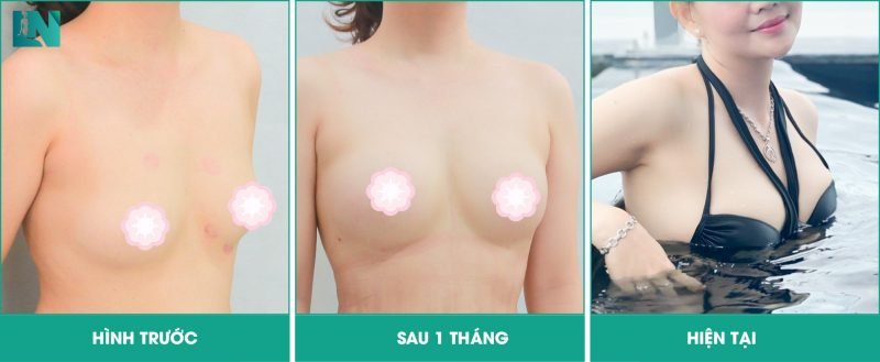 rủi ro khi cấy mỡ tự thân