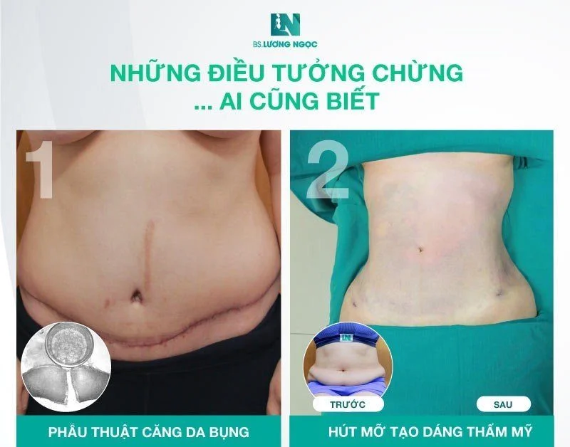 Hạn chế của phẫu thuật hút mỡ căng da bụng