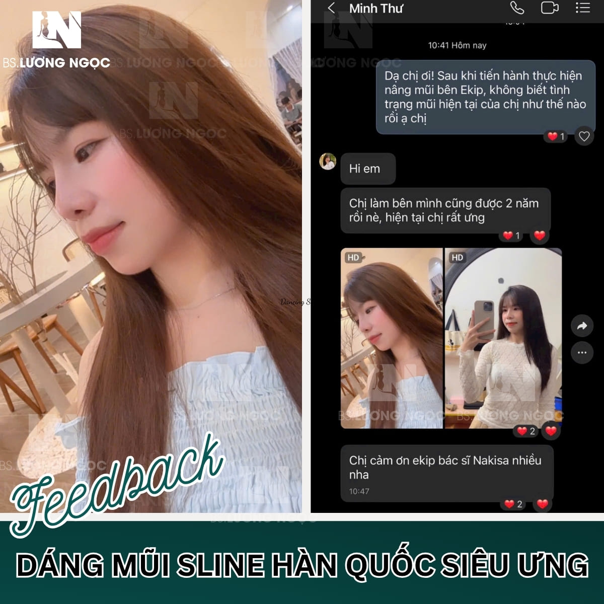 Feedback dáng mũi Sline 2 năm tuổi của khách hàng